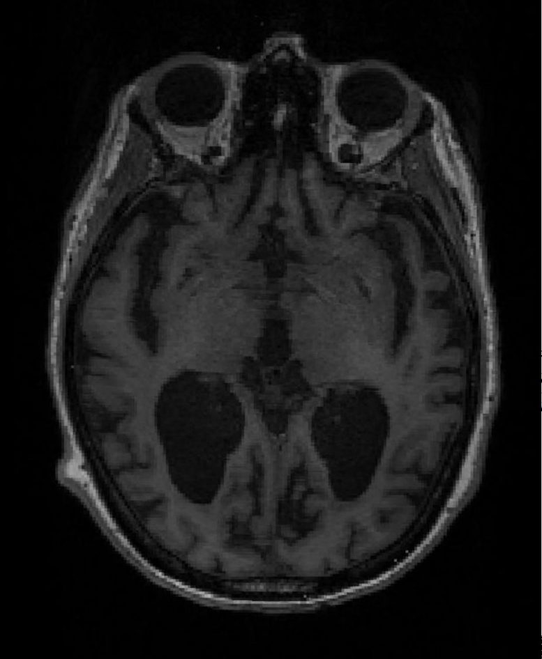 IRM du cerveau d'un patient atteint d'Alzheimer