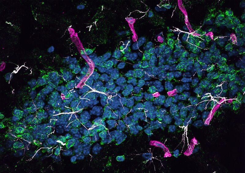Les protéines fabriquées dans le foie peuvent provoquer la maladie d'Alzheimer dans le cerveau