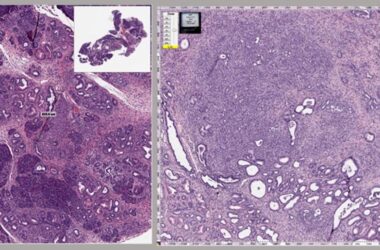 Mouse Pancreas With Cancer