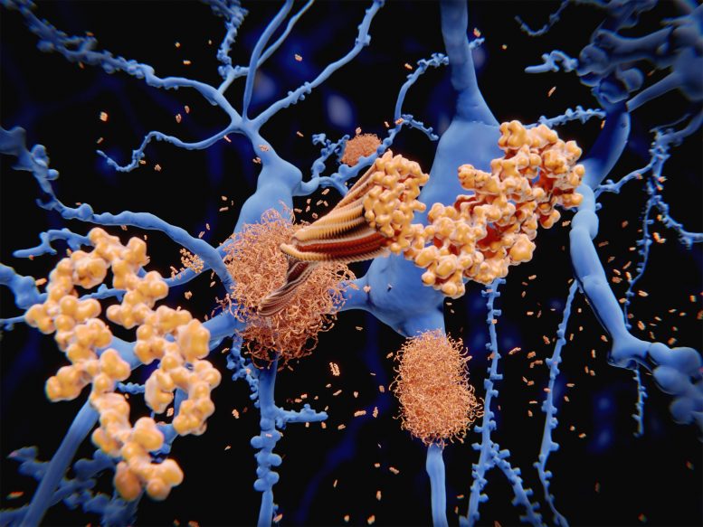 La protéine amyloïde s'agglutine le long des neurones