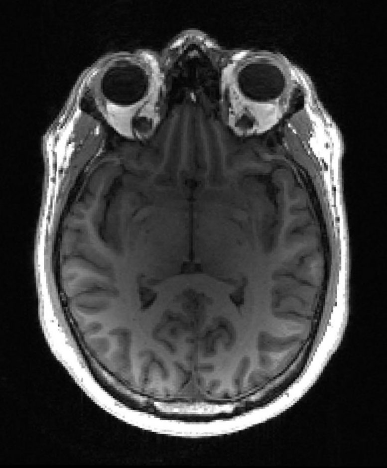 IRM saine du cerveau