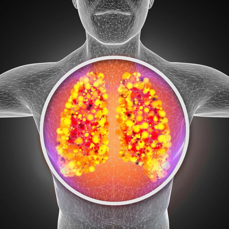 Infection du système respiratoire des poumons