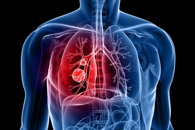 Illustration du cancer du poumon
