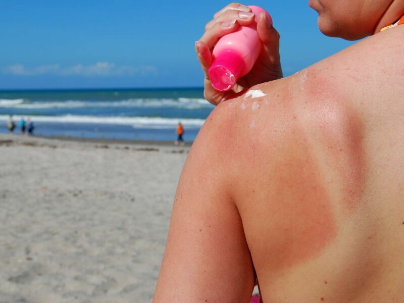 Sunscreen Sunburn