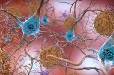Beta-Amyloid Protein in the Brain Form Plaques