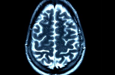 Normal Healthy Brain MRI Scan