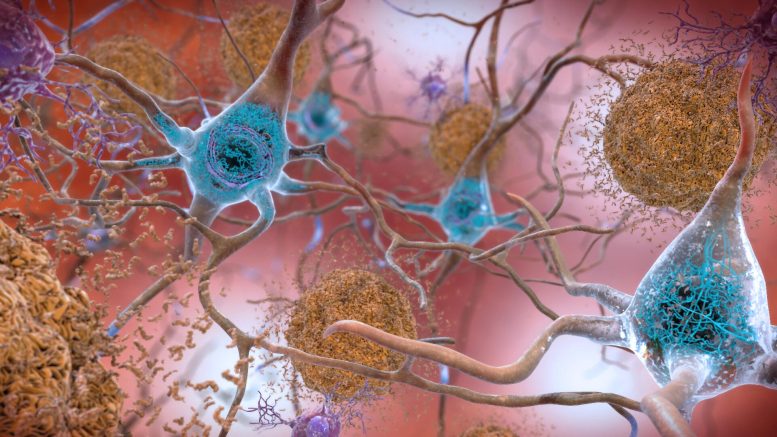 La protéine bêta-amyloïde dans le cerveau forme des plaques