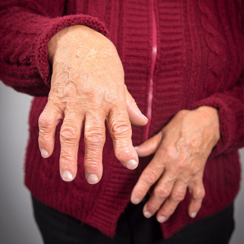 Polyarthrite rhumatoïde mains