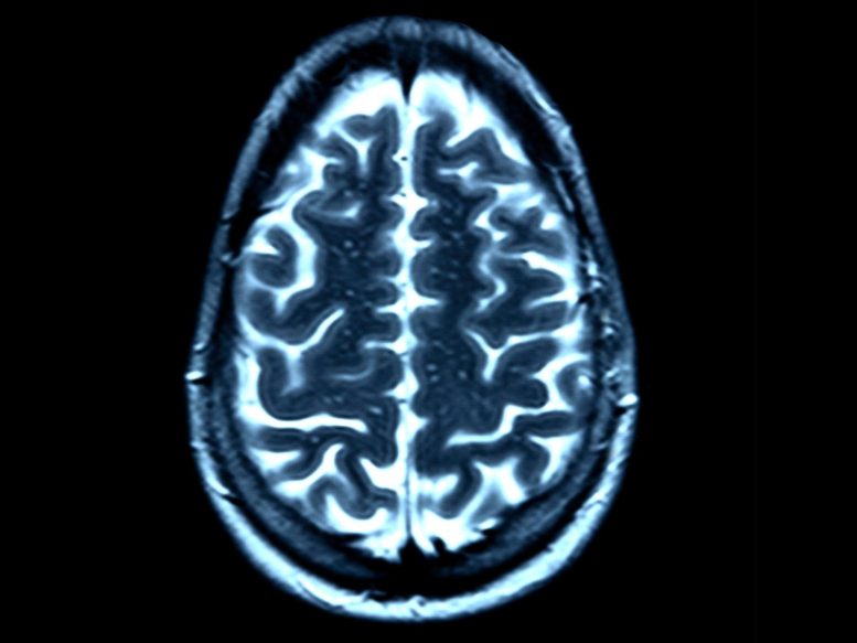 IRM normale du cerveau sain