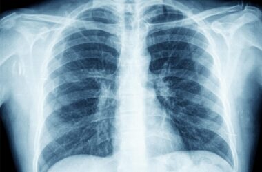 Chest X-ray Image