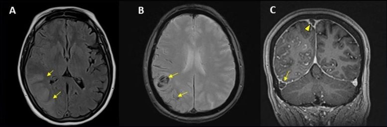 Hémorragie du scanner cérébral COVID-19