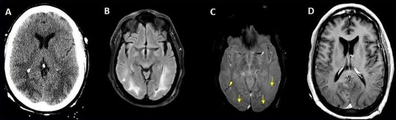 Eddème cérébral COVID-19 Brain Scan
