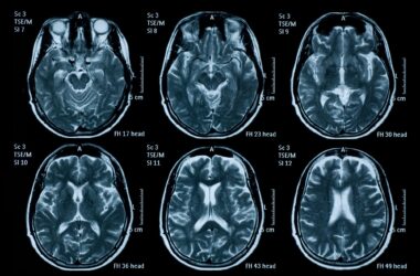 MRI Brain Scans