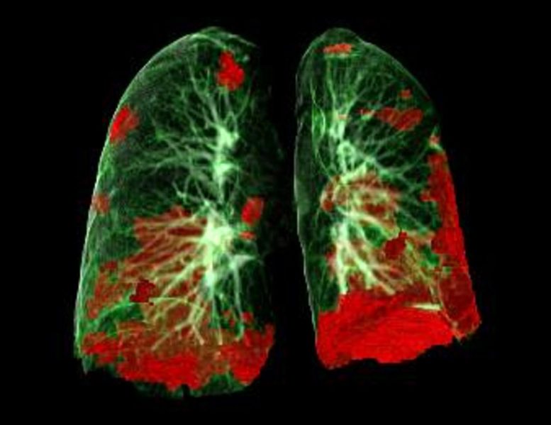 Lésions pulmonaires du patient sous COVID-19