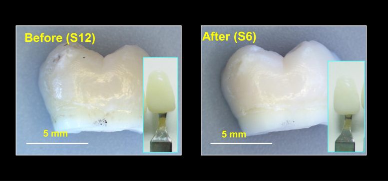 Nouveaux échantillons de dents blanchies au gel de blanchiment