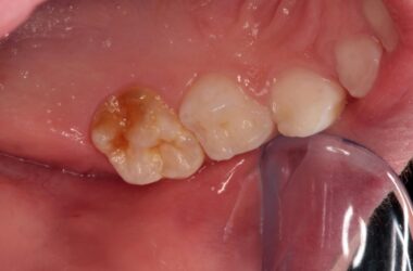 Le mystère centenaire des « dents de craie » des enfants expliqué – affecte 1 enfant sur 5