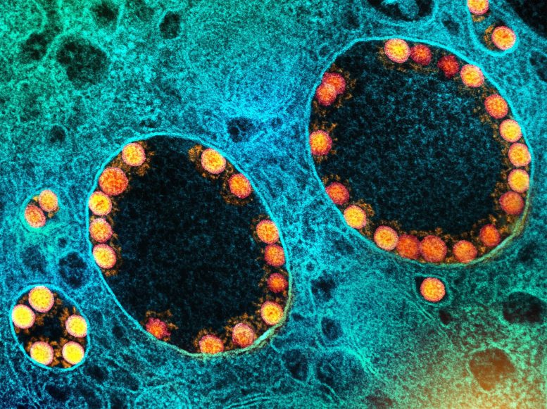 Les particules du virus SRAS-CoV-2 dans les endosomes