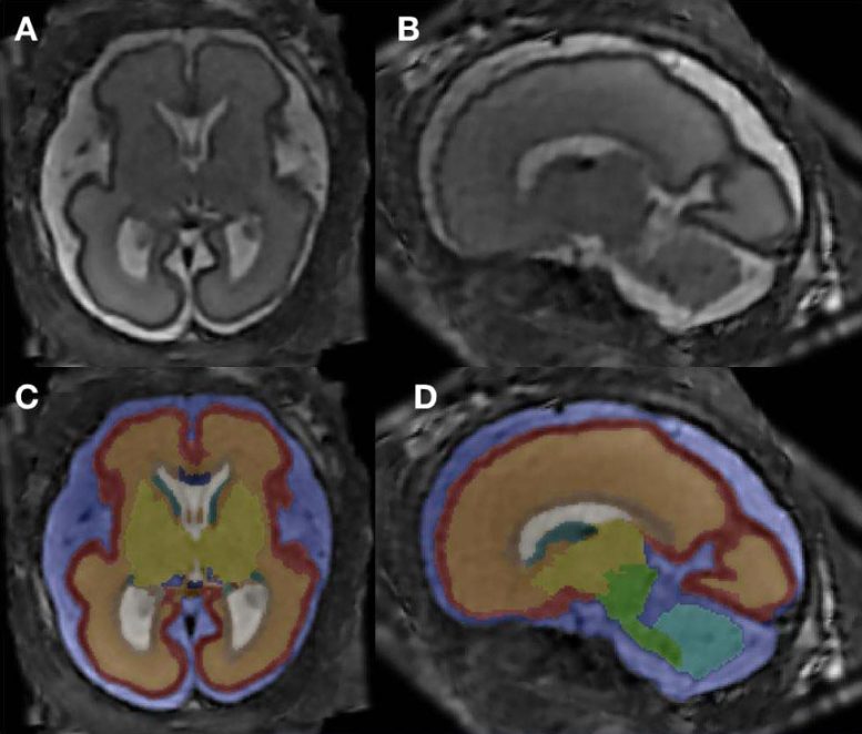 L'IRM révèle une structure cérébrale altérée chez les fœtus exposés à l'alcool