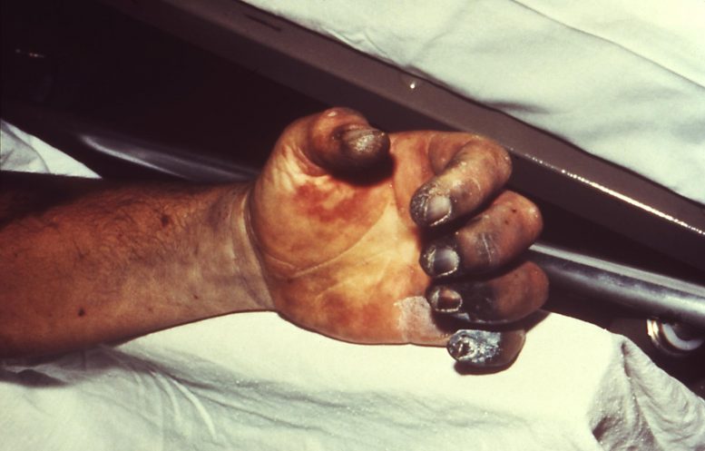 Main gauche d'une victime de la peste