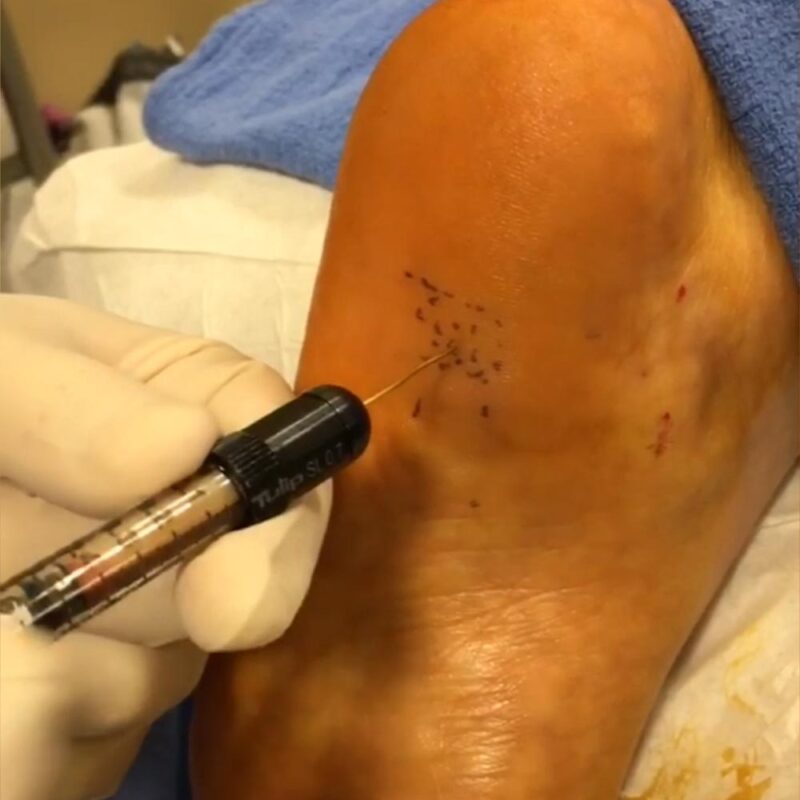 Des injections de graisse pourraient traiter la fasciite plantaire - une cause fréquente de douleur du pied