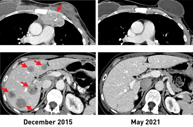 Breast Cancer Before and After Immunotherapy