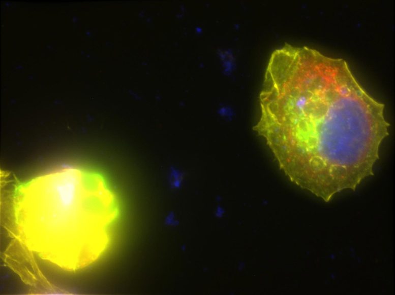 Cellules de cancer du sein traitées avec le produit thérapeutique MicroQuin
