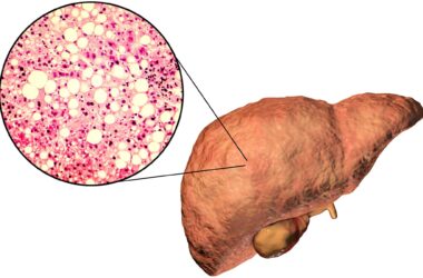 Fatty Liver Illustration and Micrograph
