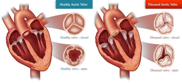 Valvulopathie aortique cardiaque