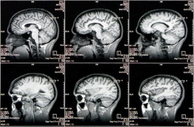 Multiple CAT Scan Brain Images
