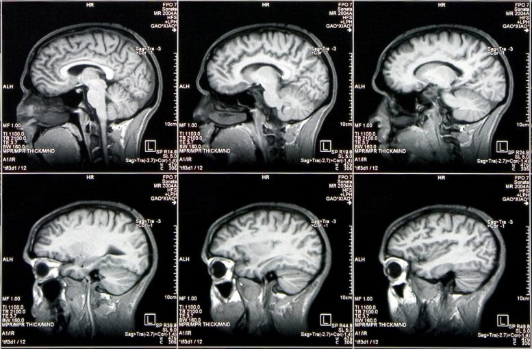 Images multiples du cerveau par scanner