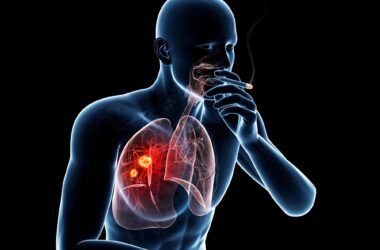 Smoking Lung Cancer Illustration