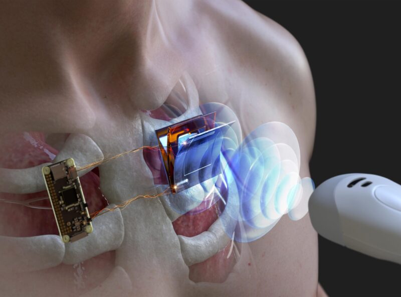 Utilisation d'ondes ultrasoniques pour charger des dispositifs électroniques immergés et implantés dans le corps humain