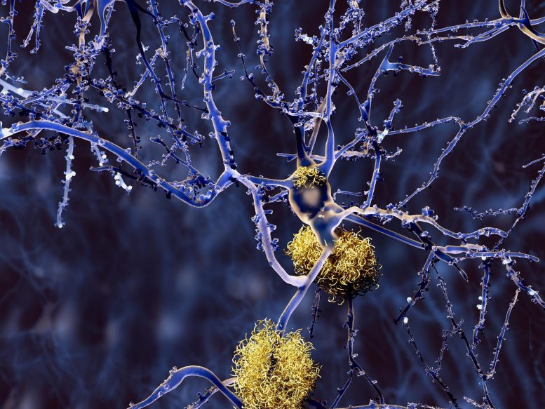 Neurones de la maladie d'Alzheimer avec des plaques amyloïdes