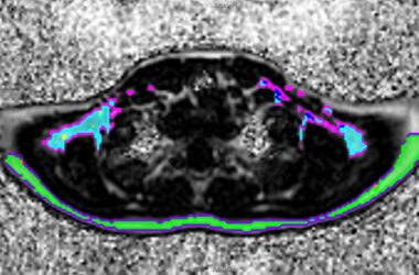 MRI Image of Brown Fat