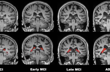 Le volume du plexus choroïde dans le cerveau est lié à la maladie d'Alzheimer