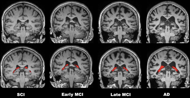 Le volume du plexus choroïde dans le cerveau est lié à la maladie d'Alzheimer
