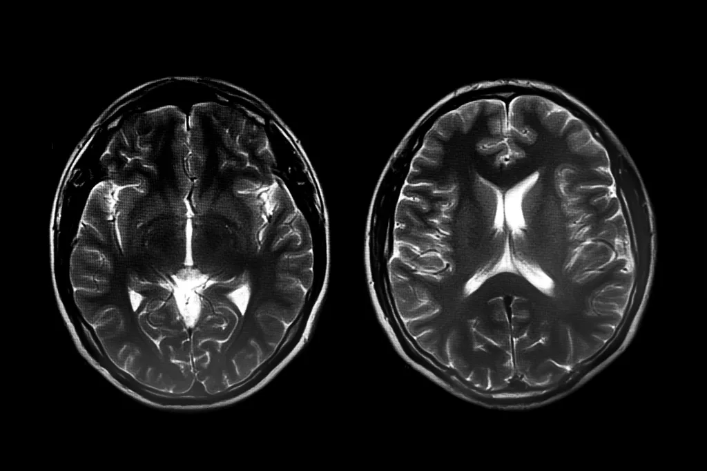 Deux scanners cérébraux