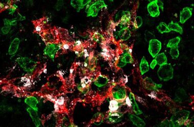 Killer-T Cells Attack Lymphatic Vessels