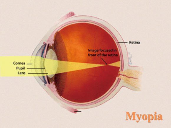 La 7-méthylxanthine peut ralentir la progression de la myopie chez les enfants. Crédit image : National Eye Institute.
