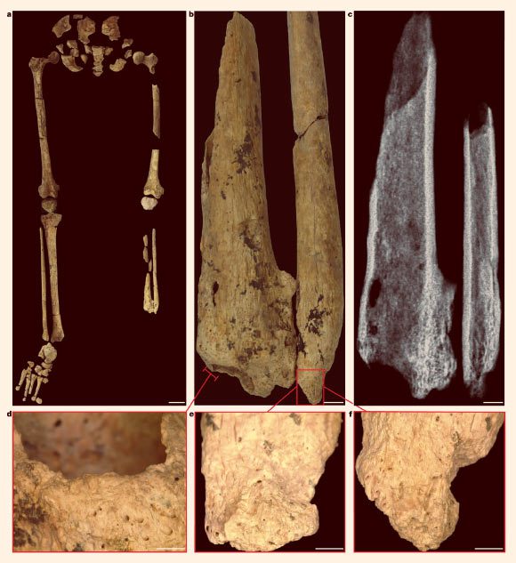 Site amputé chirurgicalement du tibia et du péroné gauches de l'individu Liang Tebo : (a) jambes gauche et droite avec ceinture pelvienne, démontrant l'absence complète du tiers distal de la jambe gauche ; (b) tibia et péroné gauches montrant la surface d'amputation, l'atrophie et la nécrose ; la surface osseuse est plus poreuse car une lyse s'est produite pour éliminer l'os mort (nécrose) ; (c) radiographie du tibia et du péroné gauches ; (d) aspect médial du tibia gauche ; (e) aspect médial du tibia gauche ; (f) aspect antérieur du péroné gauche. Barres d'échelle - 5 cm dans (a), 5 mm dans (b et c) et 2 mm dans (d-f). Crédit d'image : Maloney et al, doi : 10.1038/s41586-022-05160-8.